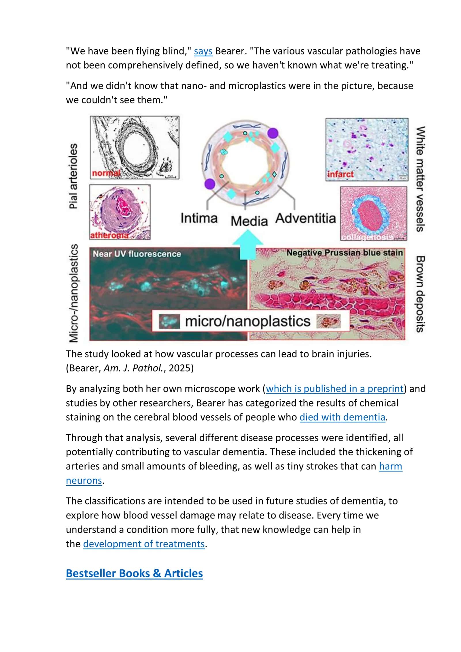 Microplastics May Be Tied to Vascular Dementia Cases, Review Finds  “Nanoplastics in the brain represent a new player in dementia.” 🧪 A groundbreaking study reveals how plastic pollution could damage blood vessels and trigger memory loss. Discover what scientists are uncovering about the hidden link between microplastics and the mind. 2