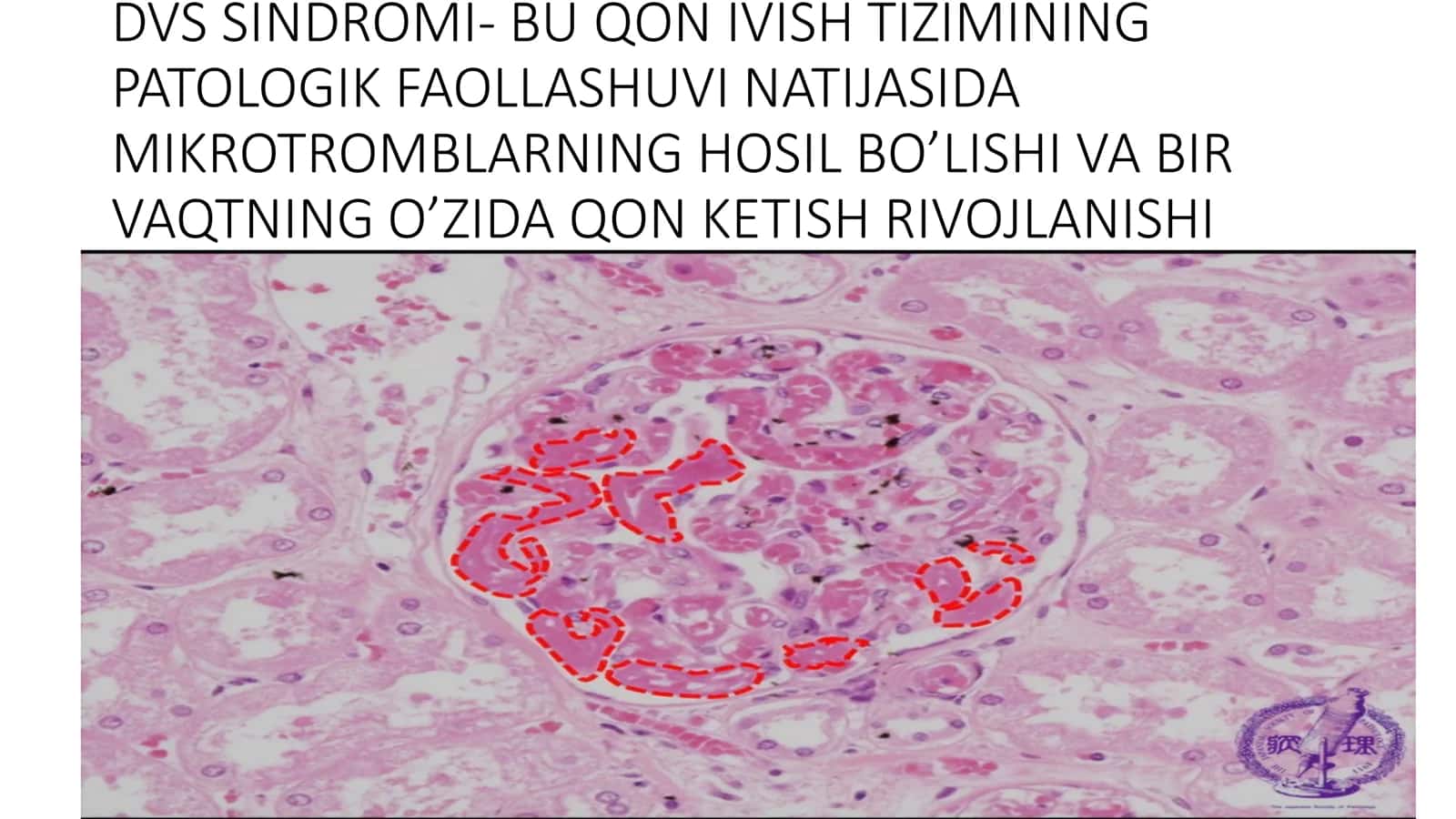 DVS sindromi 2