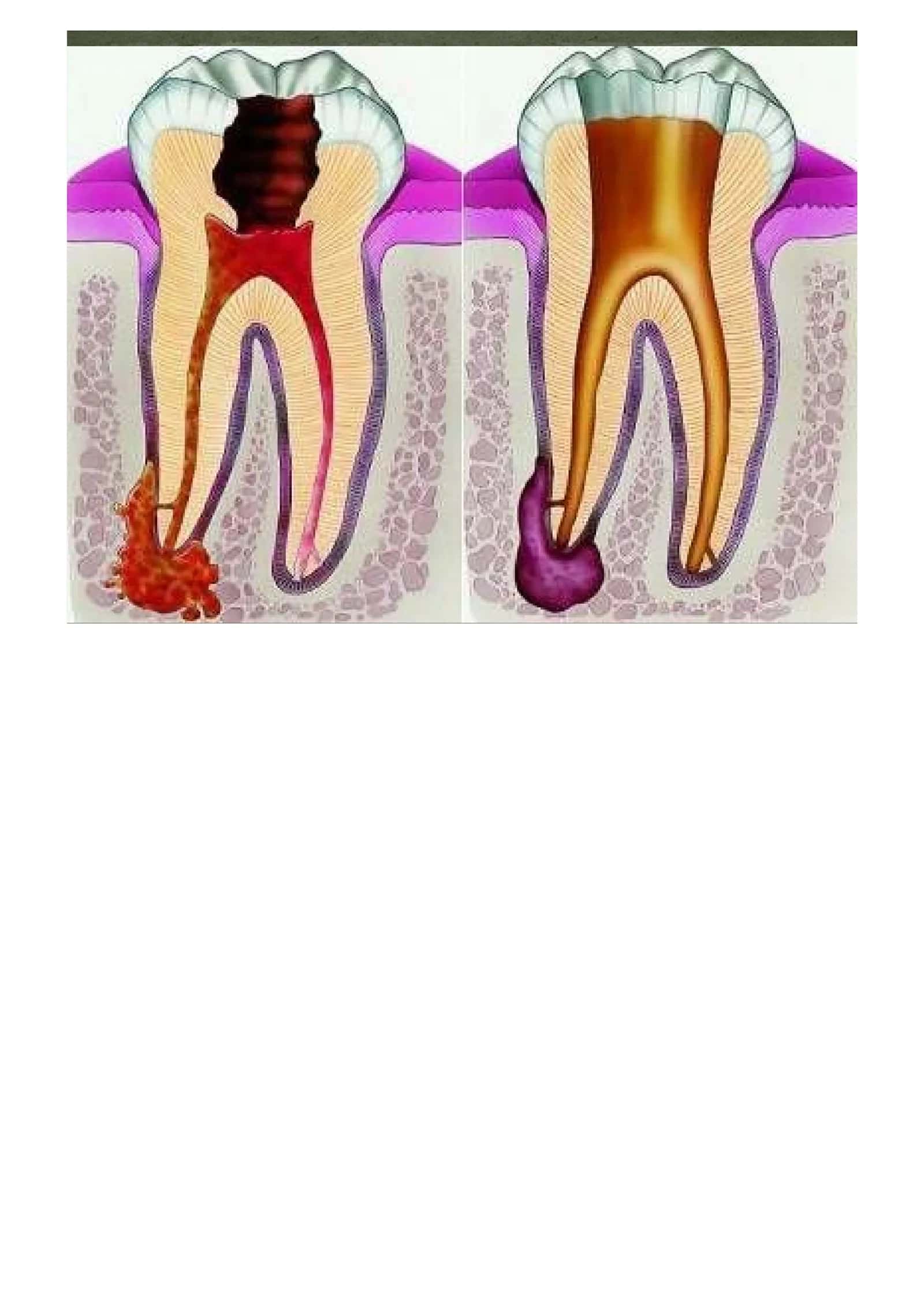 Periodontitlar 2