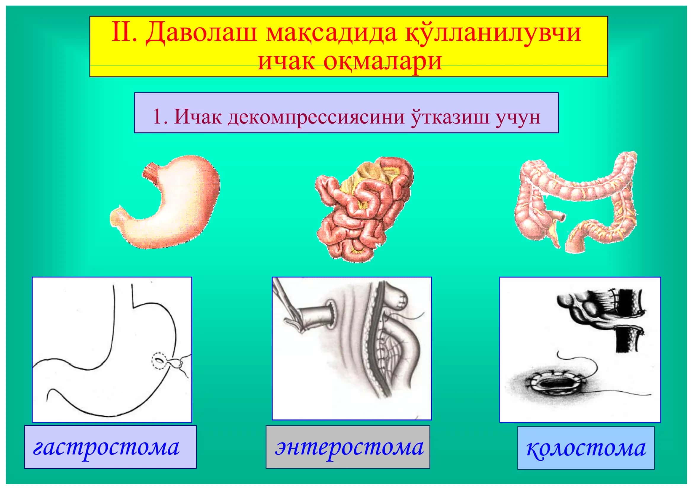 Ичак оқмалари 3