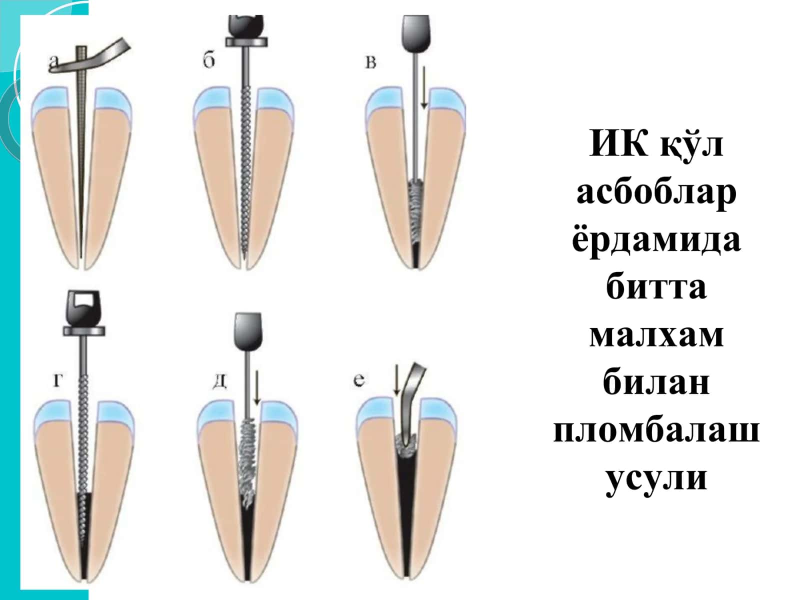 Kanalni plomba qilishda qoʻllaniluvchi plomba ashyolari 3