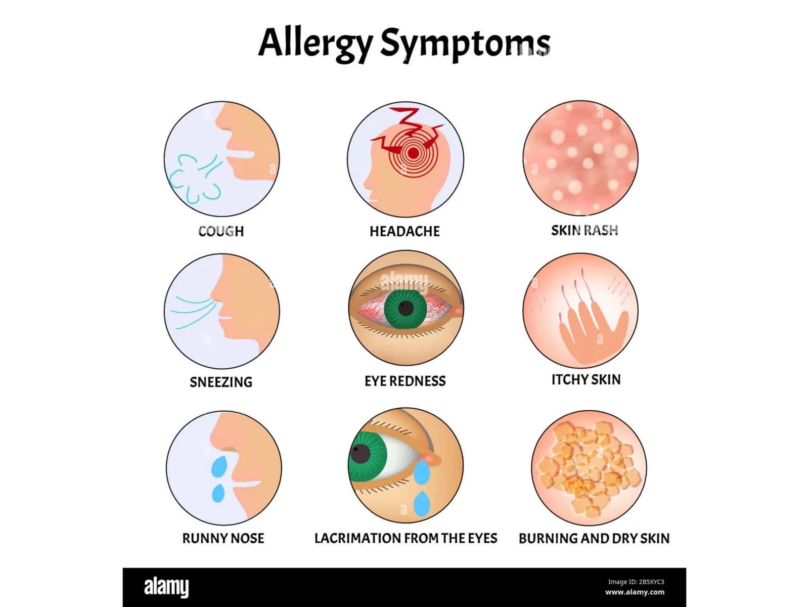 Common allergic skin Reaction and Management 3