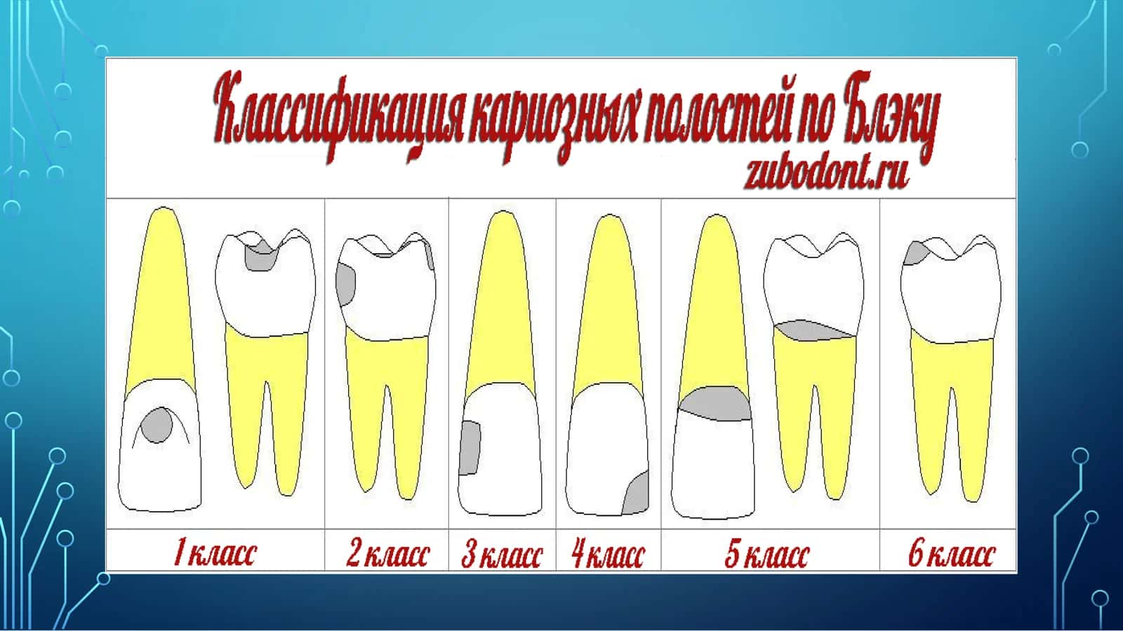 FANTOMLARDA 5-6-SINF KARIOZ BO’SHLIQLARINI CHARXLASH VA PLOMBALASH 3
