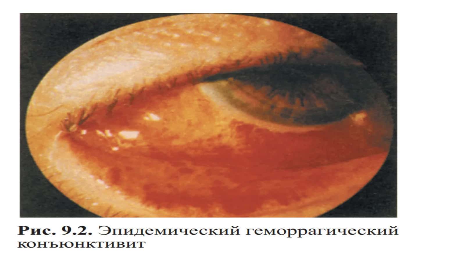 Epidemik kon’yunktivitni avj olishini oldini olish 3