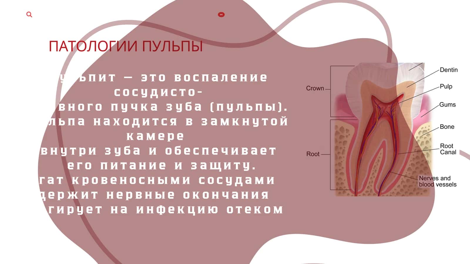 ПАТОЛОГИИ ПУЛЬПЫ 3