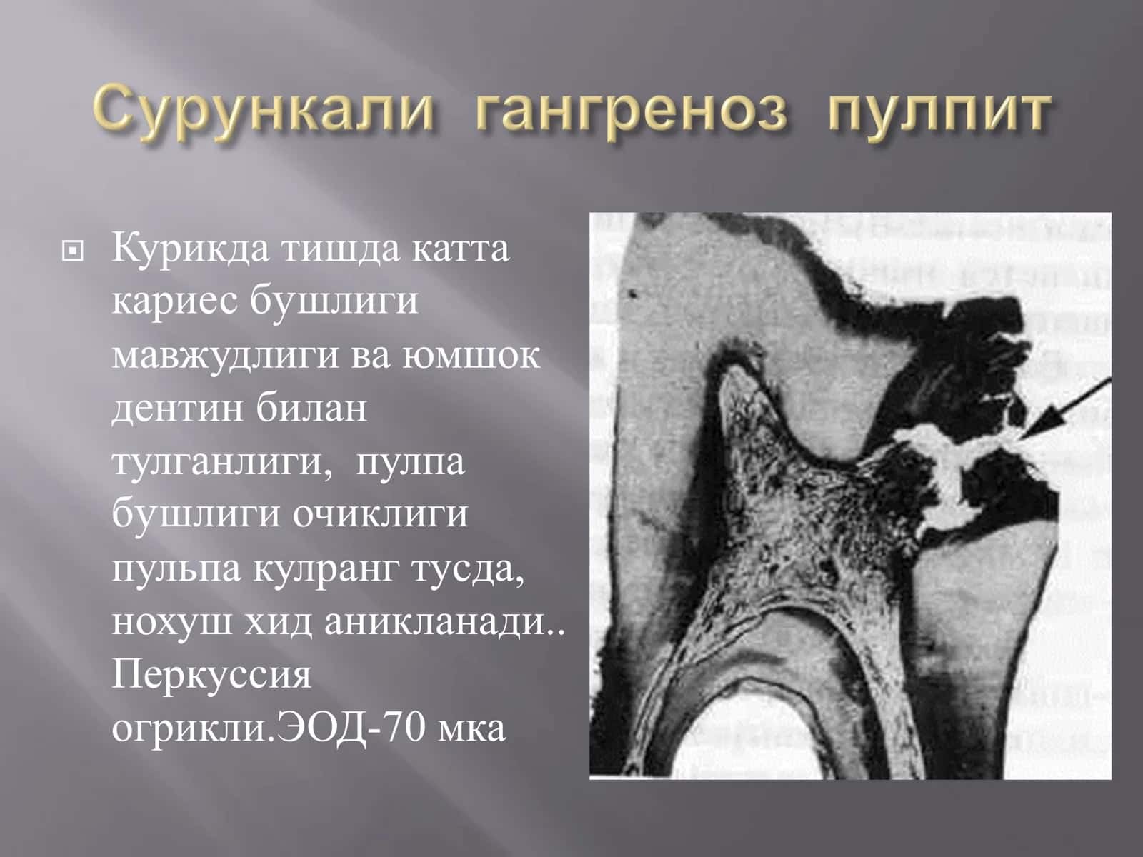 Сут тишларда кечувчи сурункали пульпитларга 3