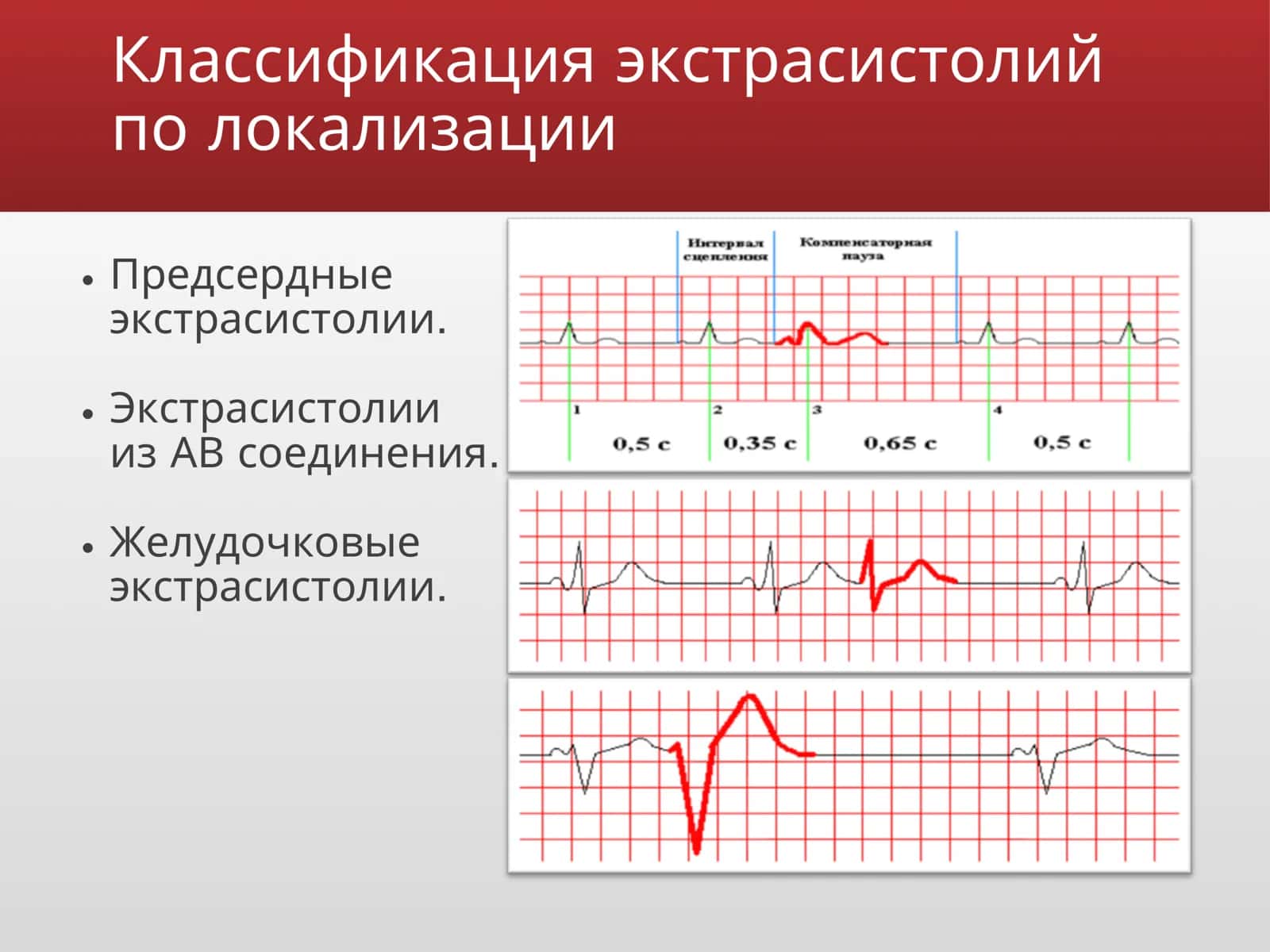 Экстрасистолии 3