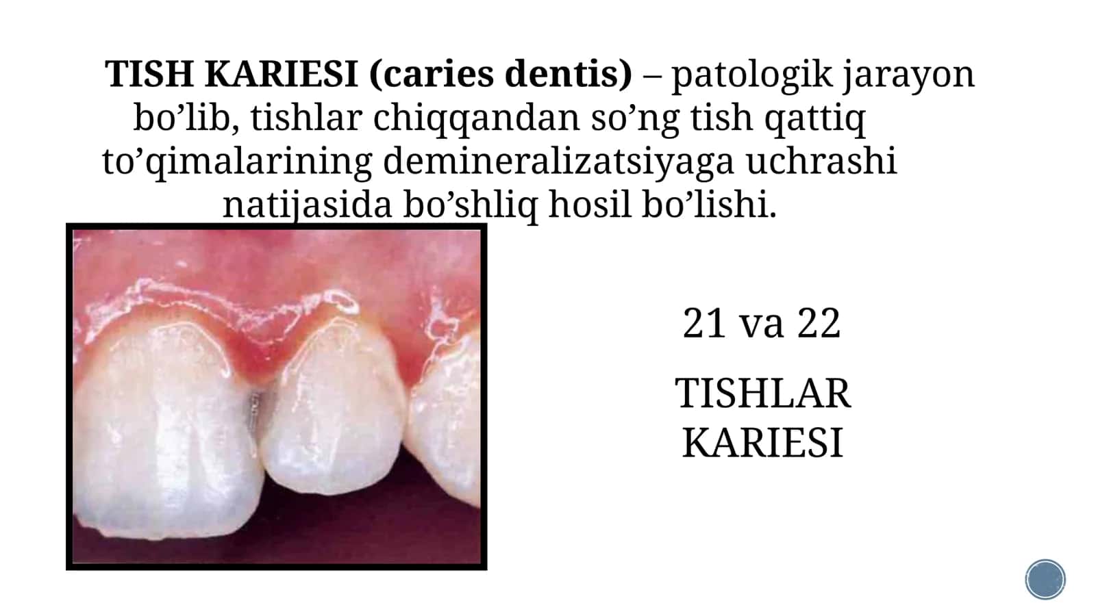 Dog’ bosqichidagi karies 3
