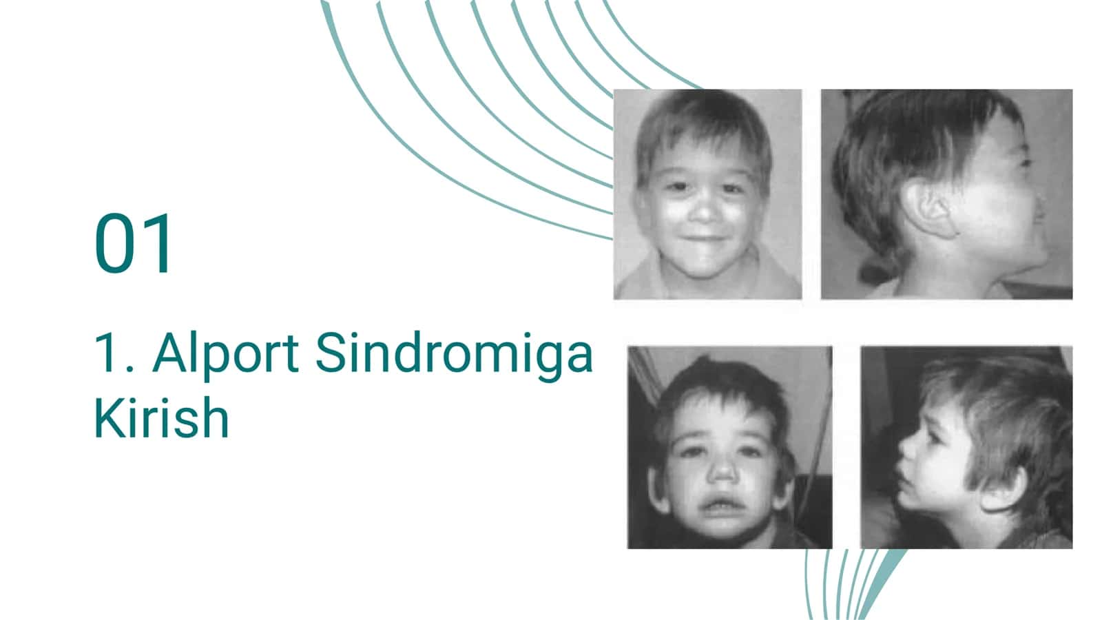 Alport Sindromi: Kelib Chiqishi, Diagnostikasi va Davolash 3