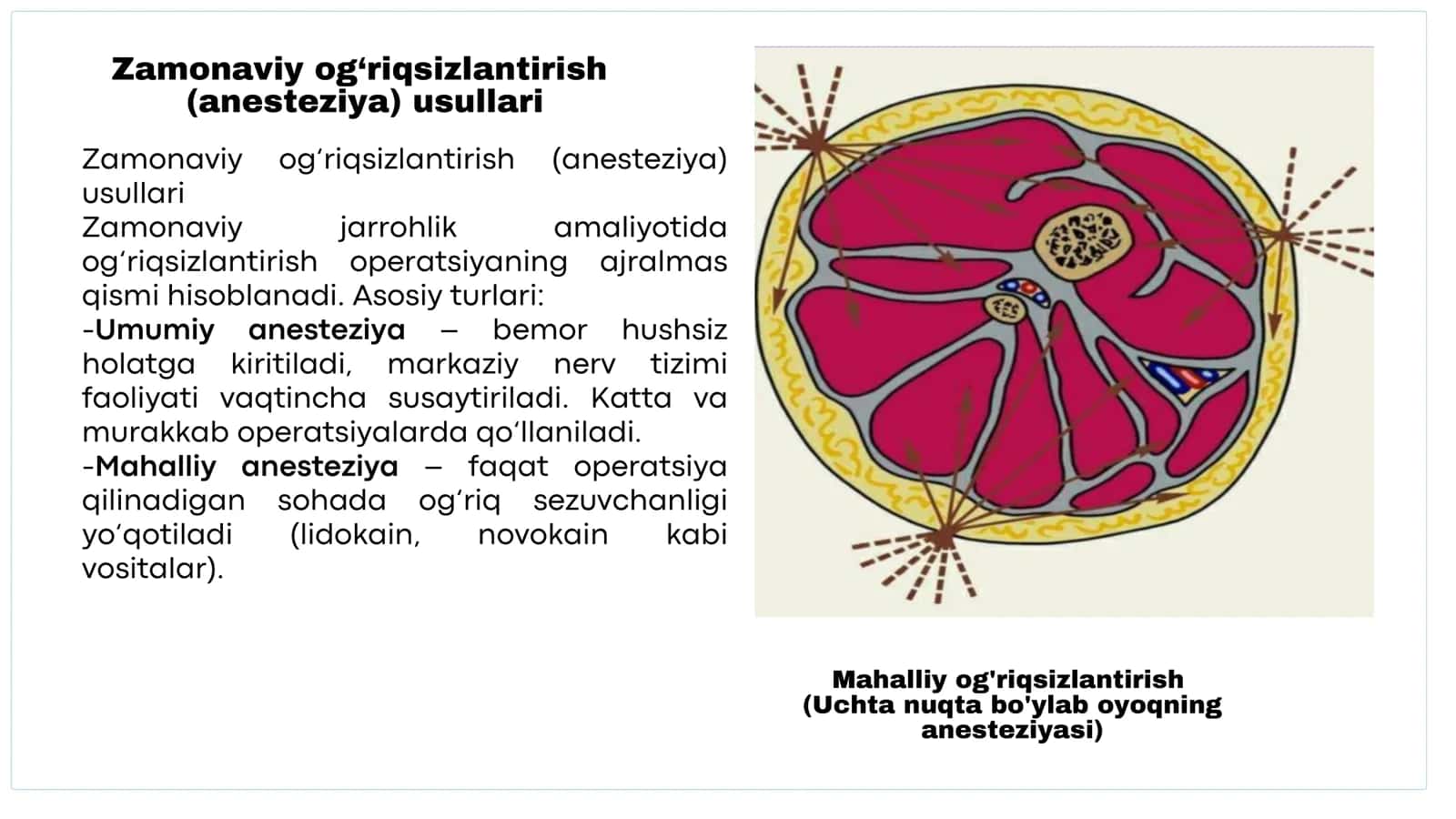 Zamonaviy jarrohlik amaliyotida og‘riqsizlantirish operatsiyasi 3