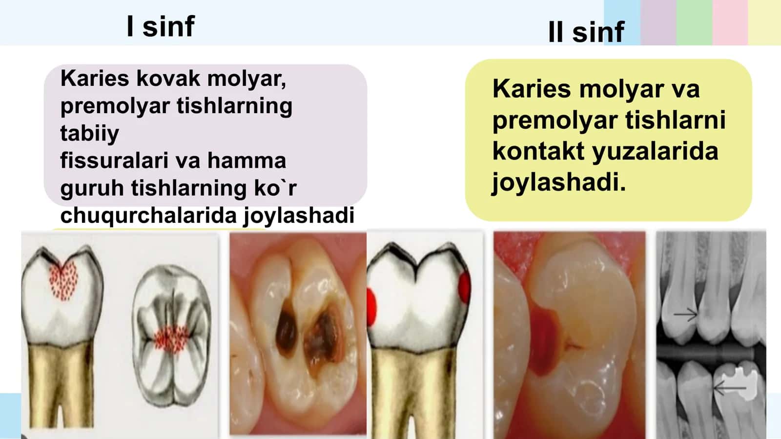 II sinf KARIOZ BO'SHLIQLARINI CHARXLASH VA PLOMBALASH 3