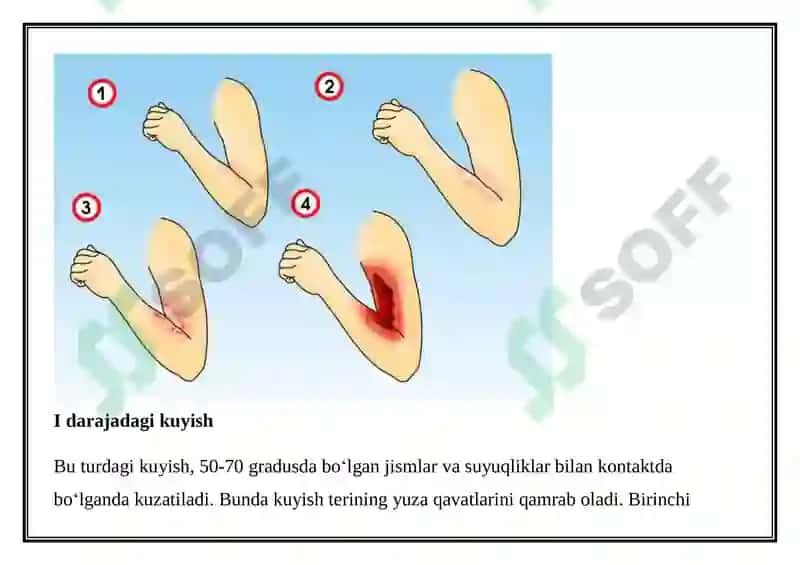 KUYISH KASALLIGINING TERAPEVTIK ASPEKTLARI 5