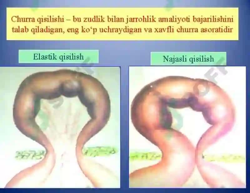 Xirurgiya churralar 6