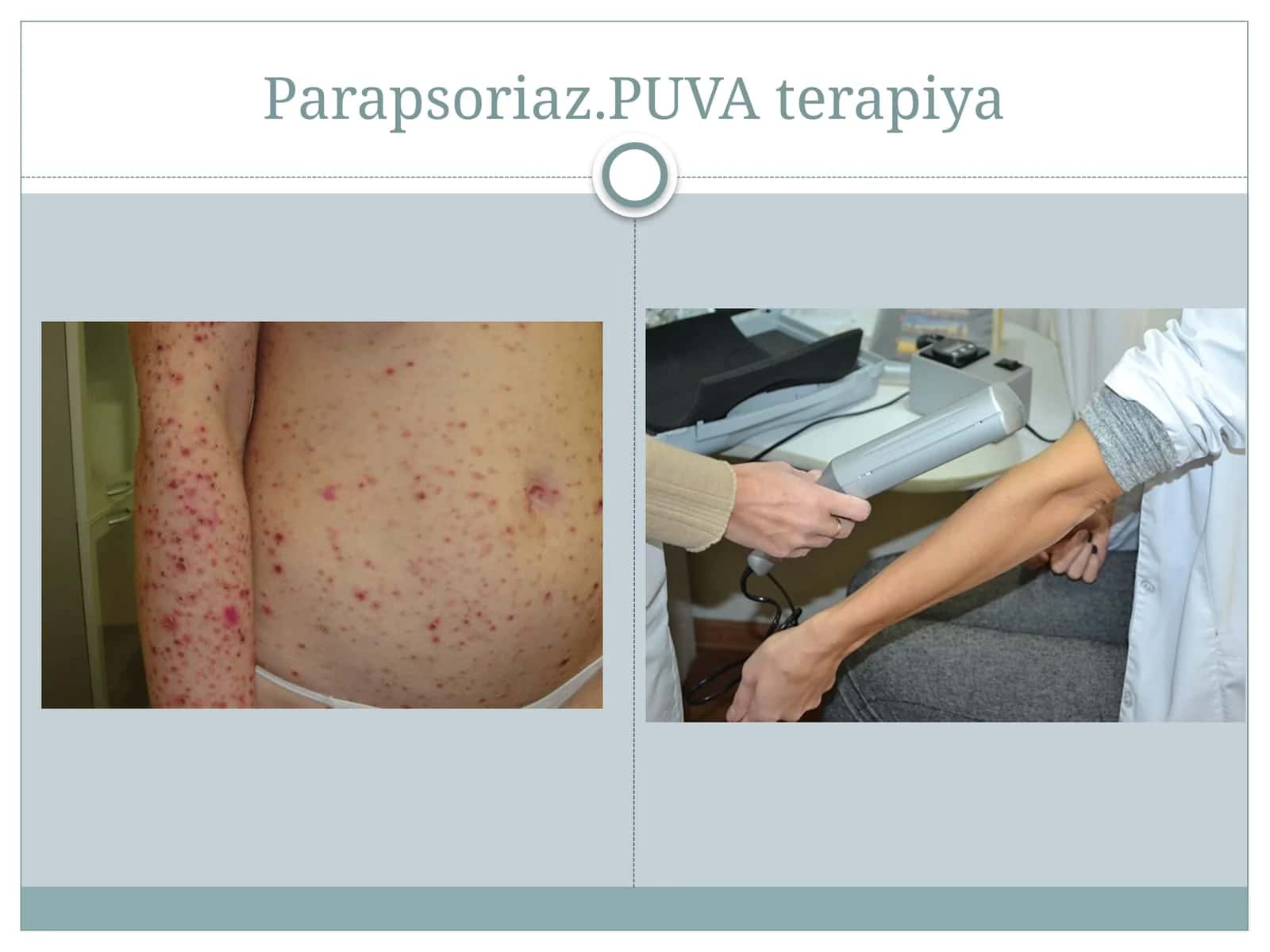 Parapsoriaz.PUVAterapiya 1