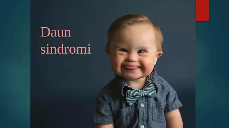 Daun sindromi 1