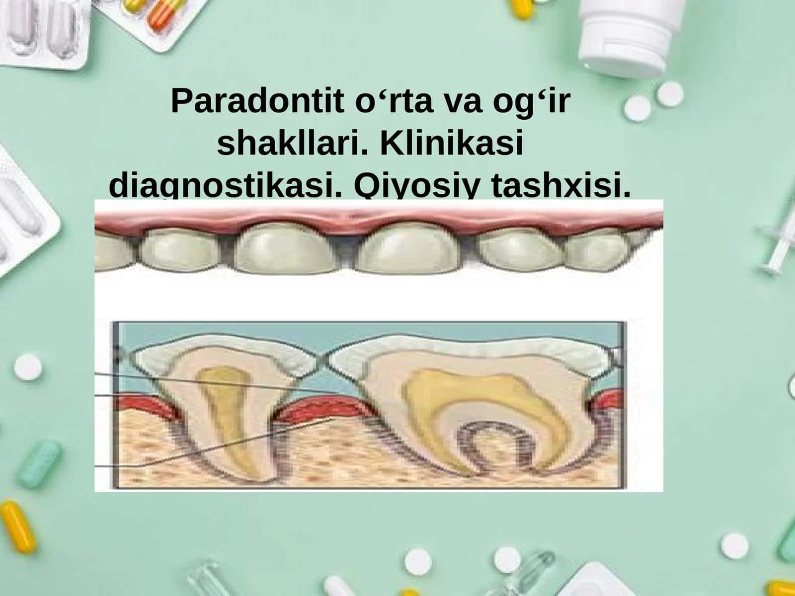 Paradontit 1