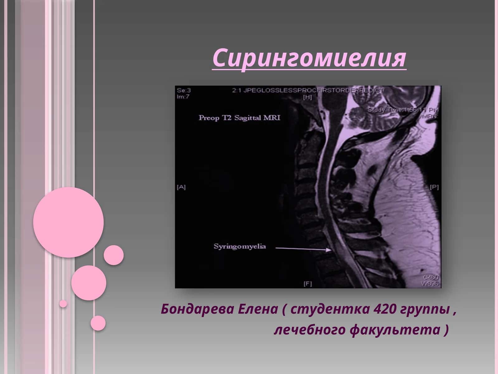 Сирингомиелия 1