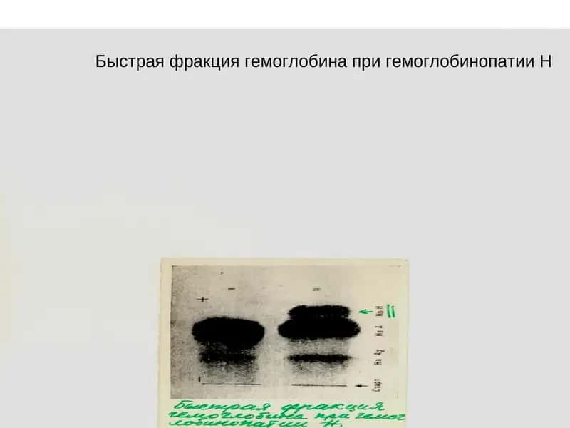 Генеологическая схема семьи с наследственной гемолитической анемией –β-талассемией 1