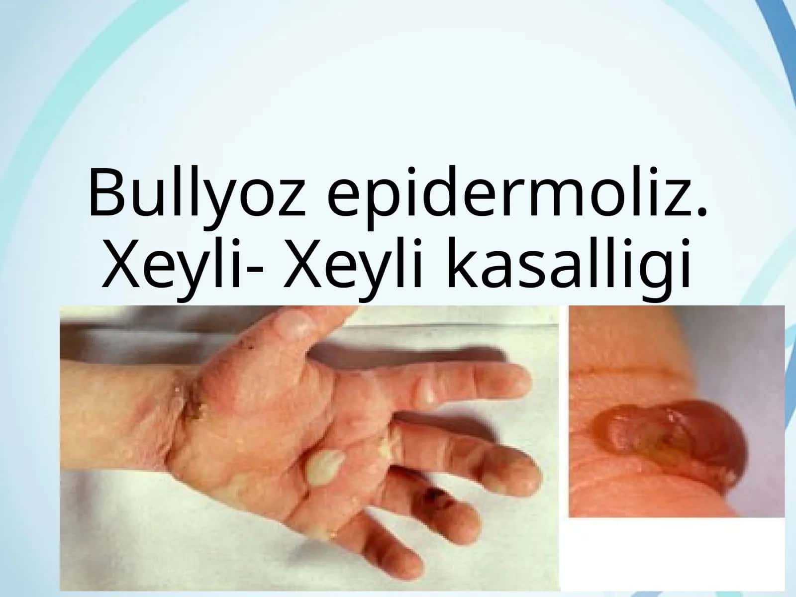 Bullyoz epidermoliz. Xeyli- Xeyli kasalligi 1