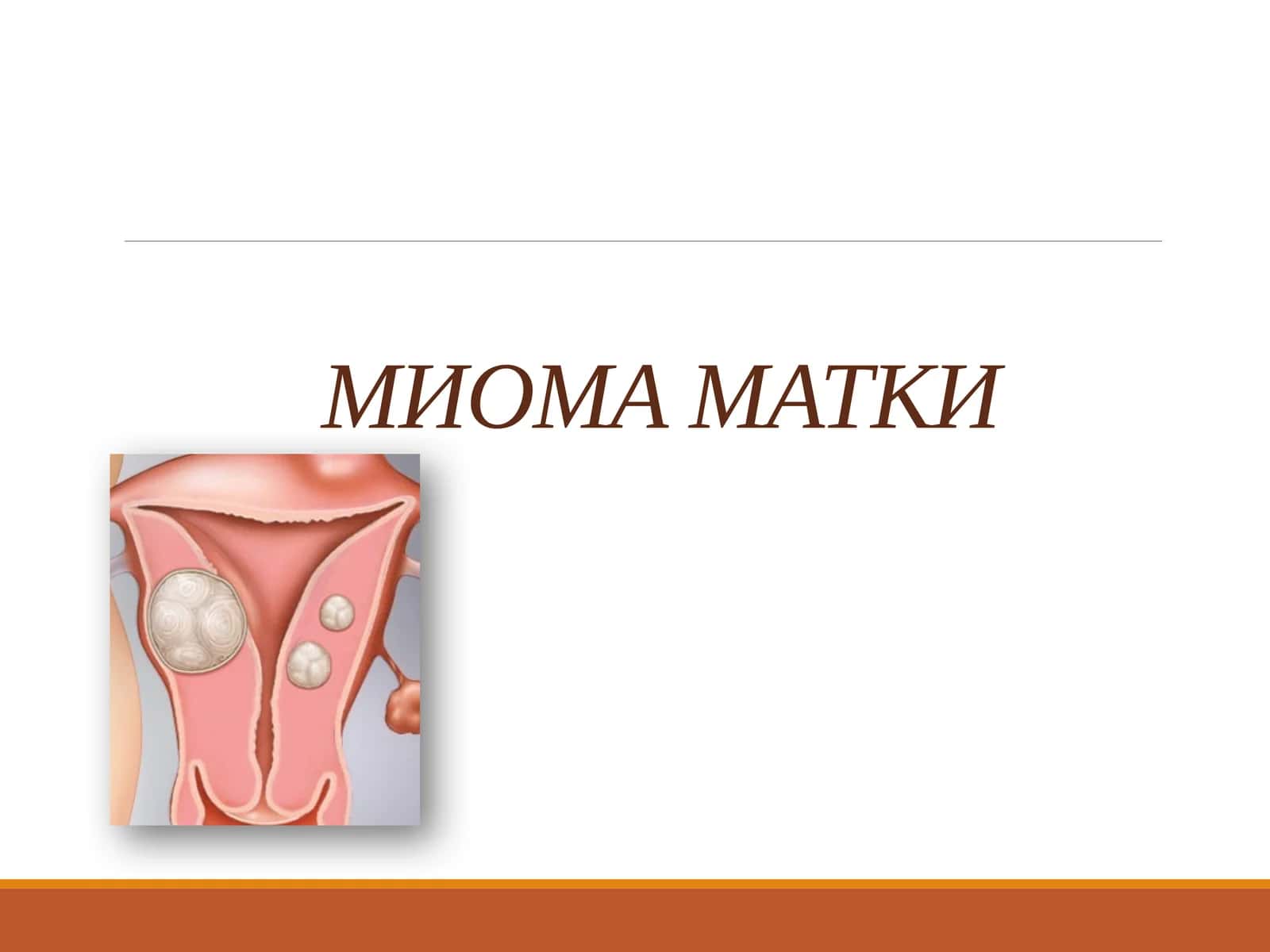 Миома матки 1