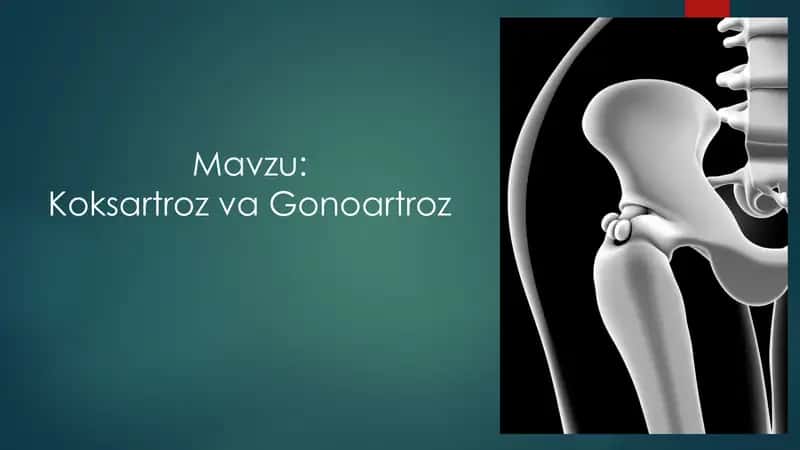 Koksartroz va gonoartroz 1
