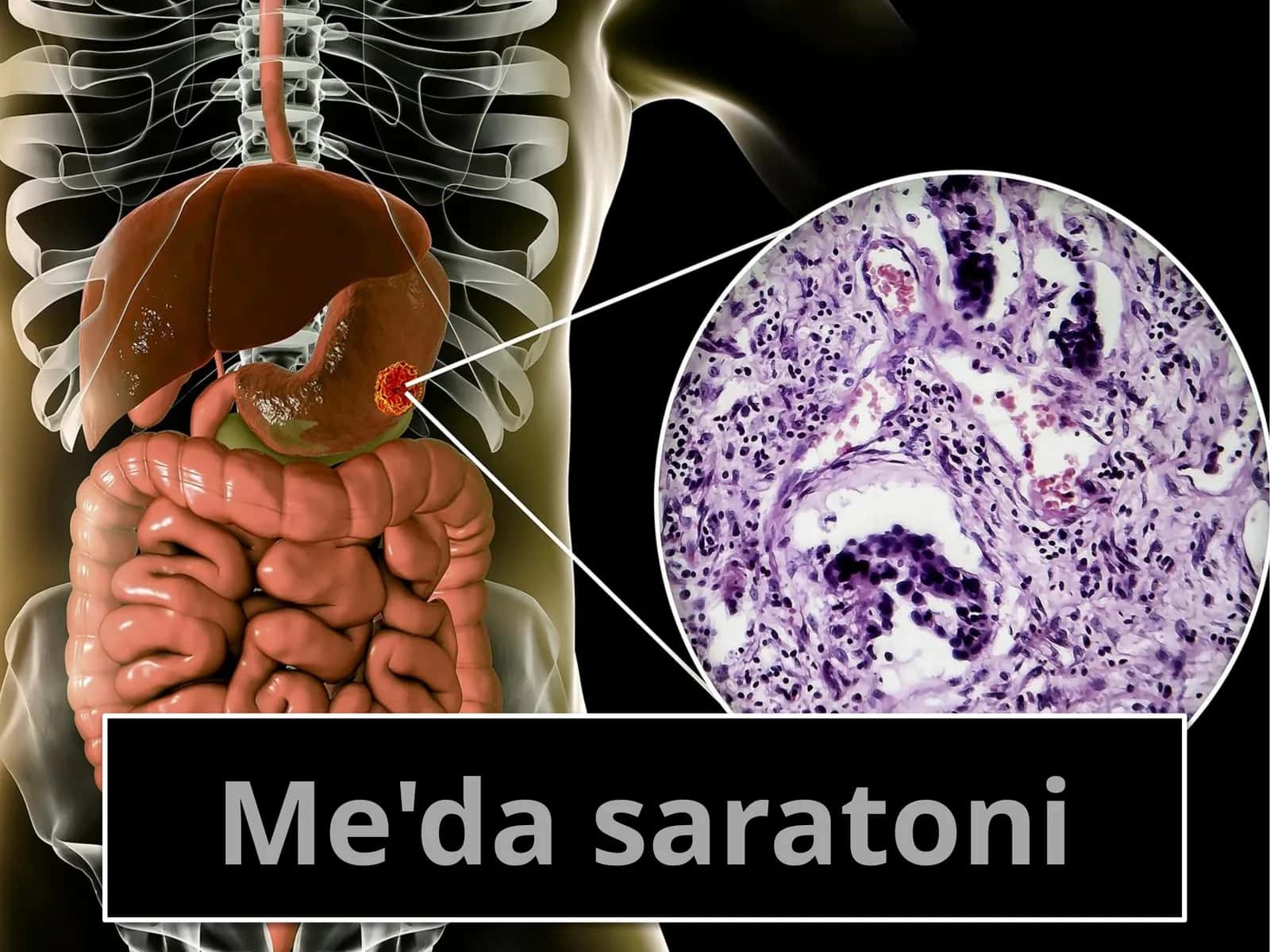 Me'da saratoni 1