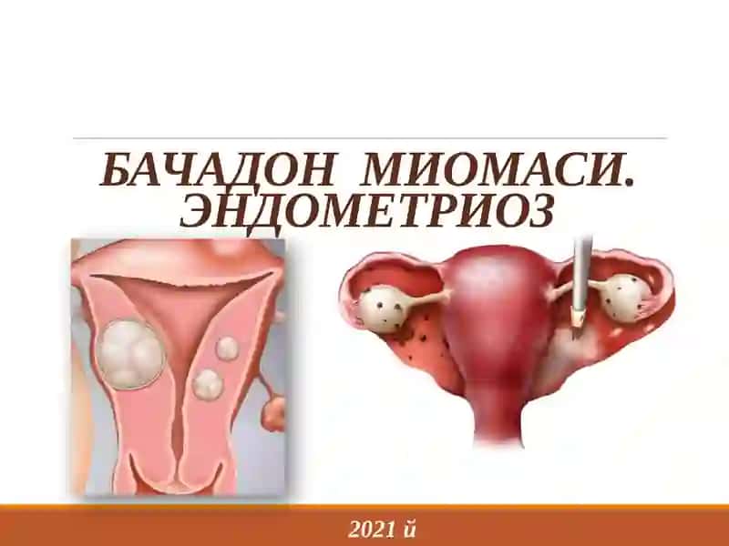 Bachadon miomasi. endometrioz