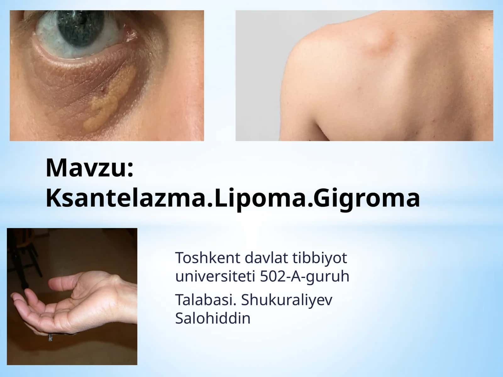 Ksantelazma.Lipoma.Gigroma 1