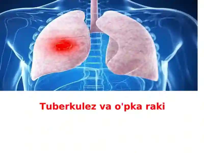 Tuberkulez va o'pka raki