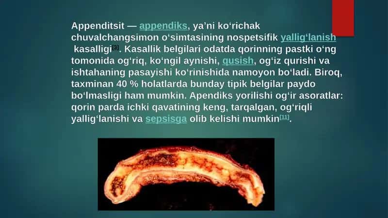 Appenditsit 1