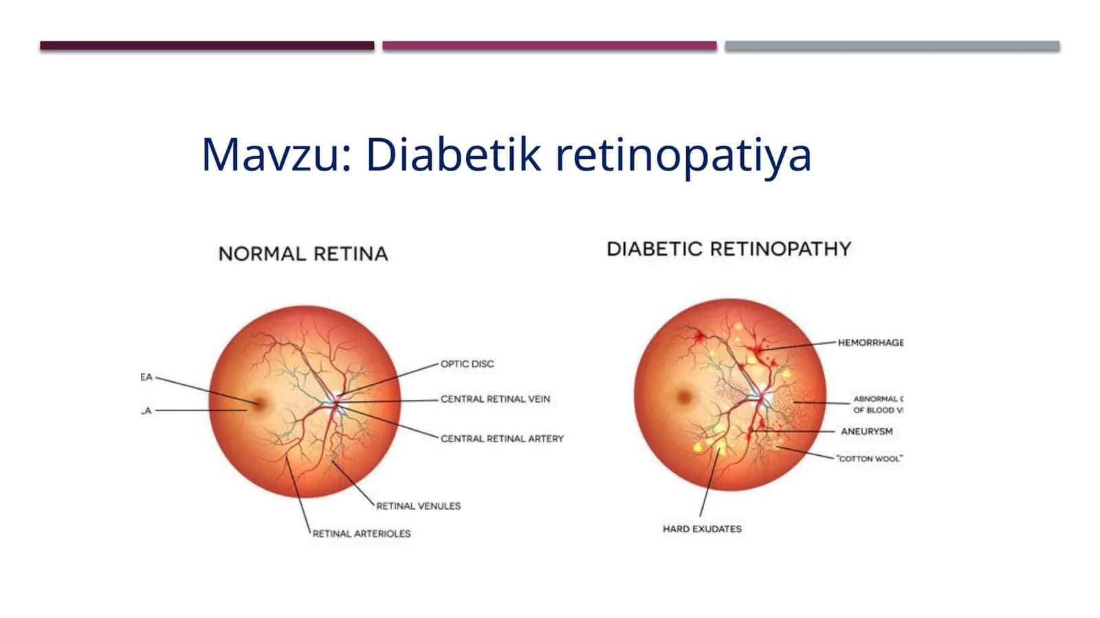 Diabetik retinopatiya 1