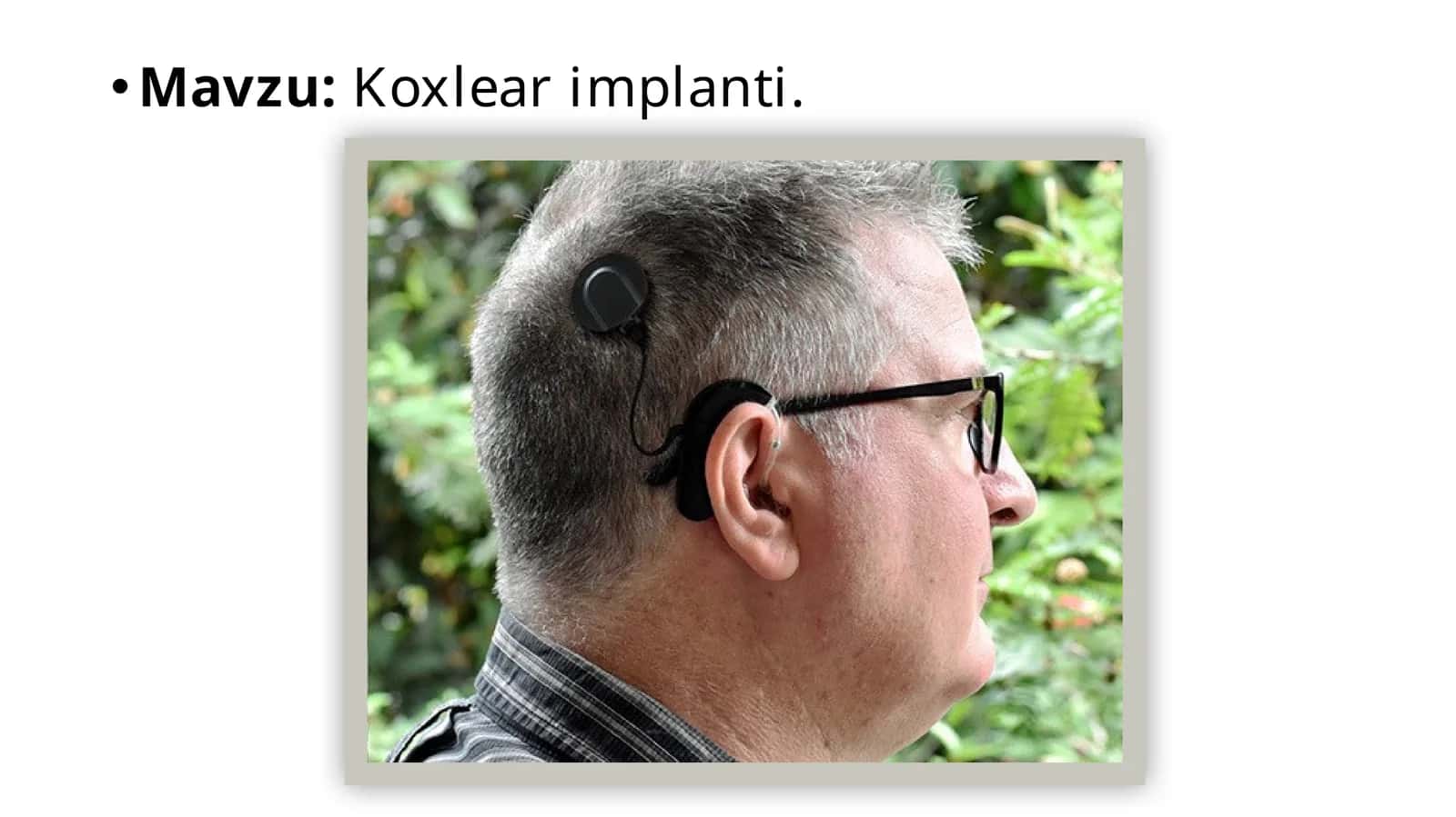 Koxlearimplanti 1