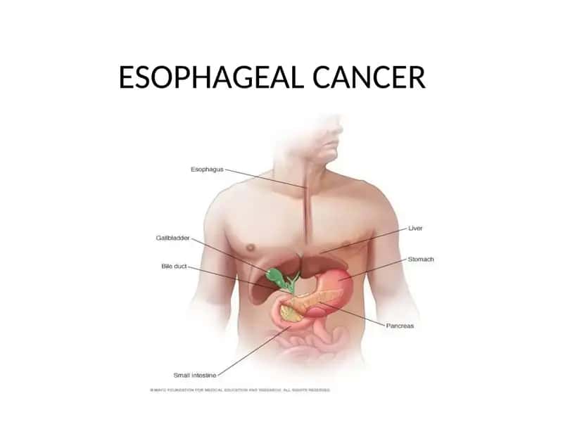 Esophageal Cancer 1