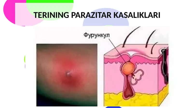 Pyoderma - terining parazitar kasaliklari 1