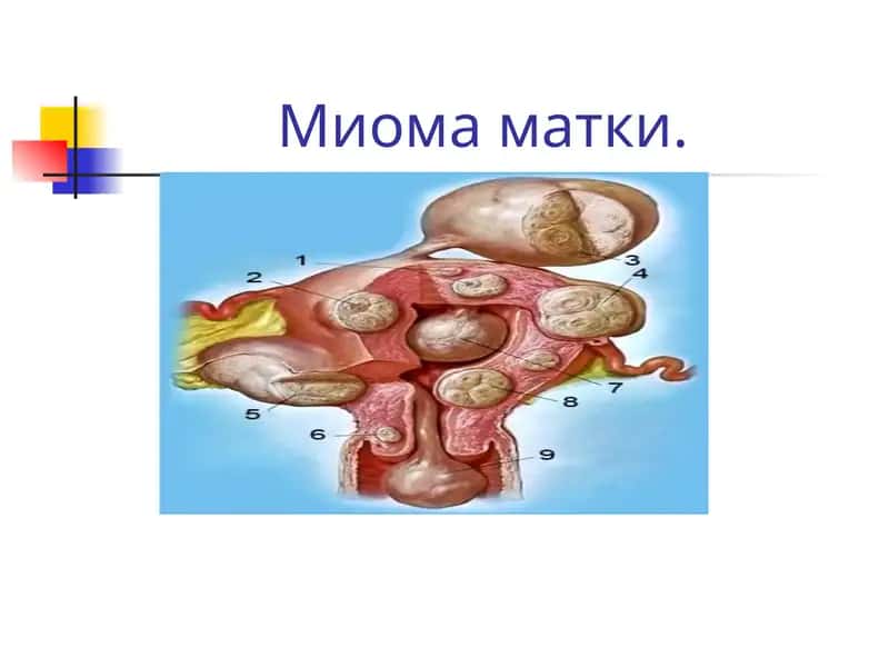 mioma 1