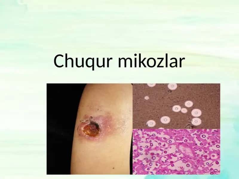 Chuqur mikozlar 1