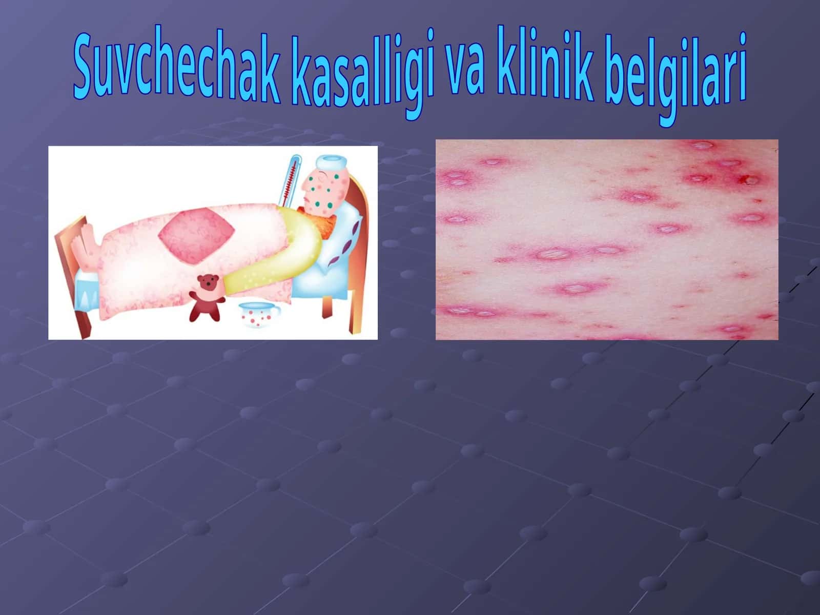 Suvchechak kasalligi va klinik belgilari 1