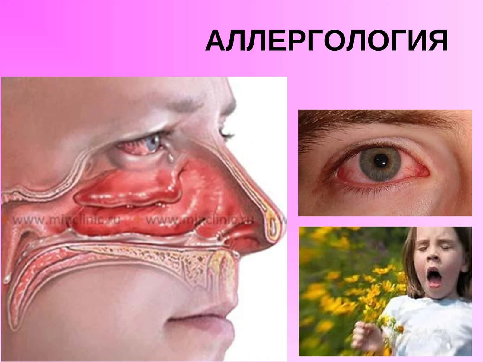 АЛЛЕРГОЛОГИЯ 1