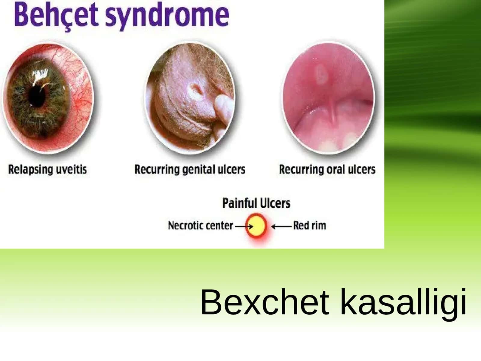 Bexchet kasalligi 1