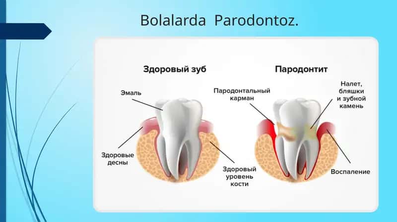 Bolalarda Parodontoz 1