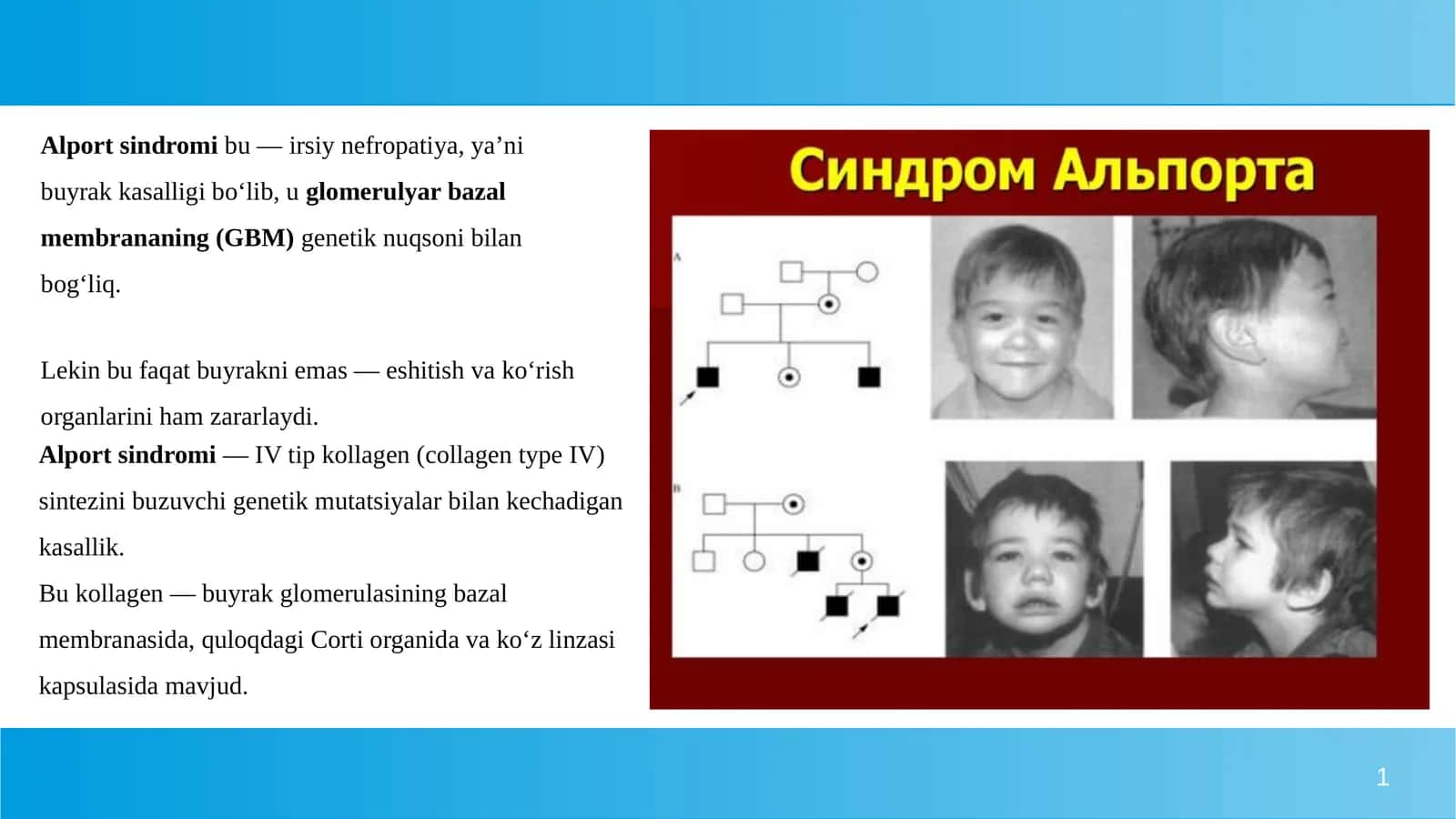 Alport sindromi 1