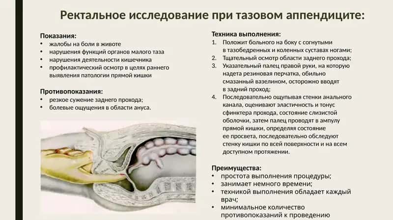 Ректальное исследование при тазовом аппендиците 1