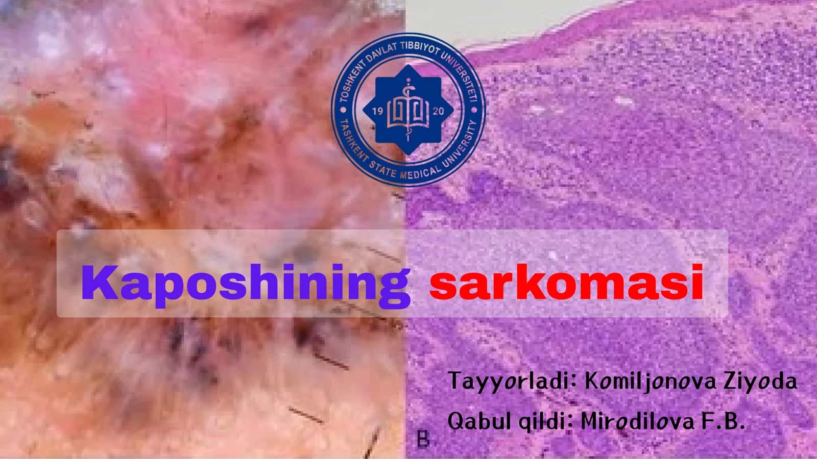 Kaposhining sarkomasi 1
