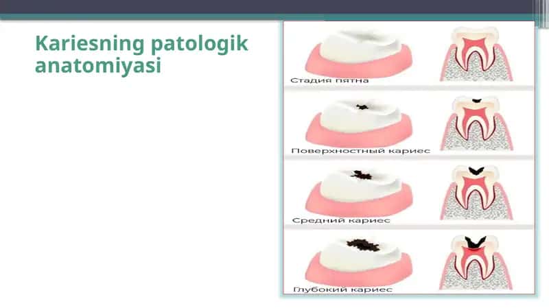 Kariesning patologika anatomiyasi 1