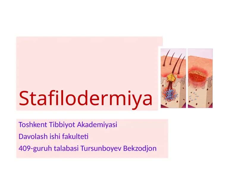 Stafilodermiya 1