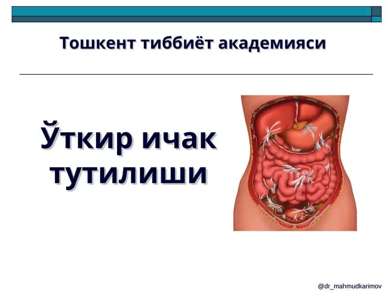 Ўткир ичак тутилиши 1