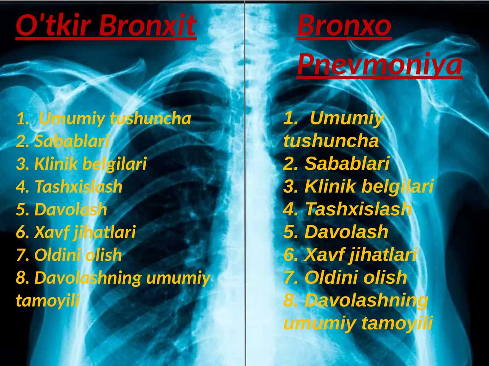 O'tkir Bronxit 1