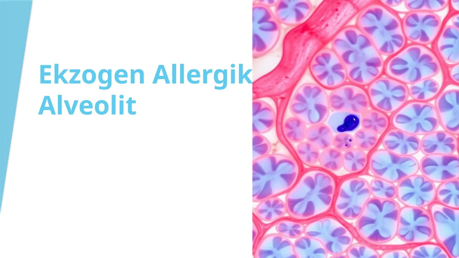 EkzogenAllergikAlveolit 1