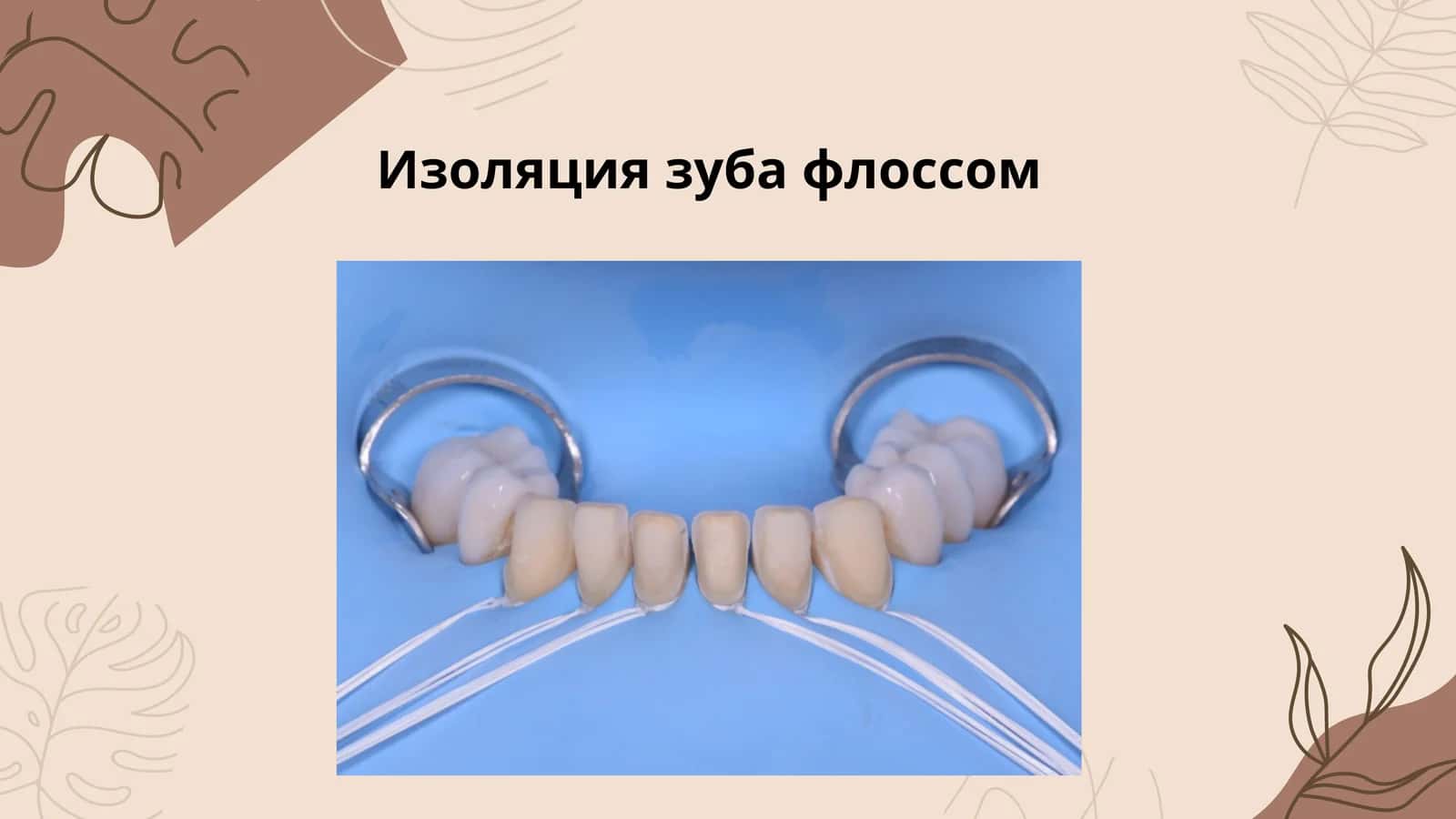 Изоляция зуба флоссом 1