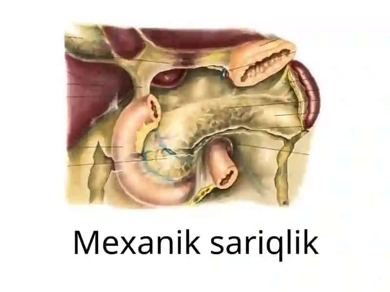 Mexanik sariqlik 1